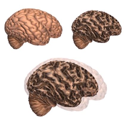 Brain changes, figure 1